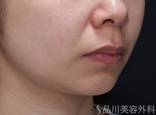 症例NO.73035のBEFORE写真