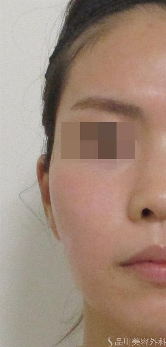 症例NO.55618のAFTER写真