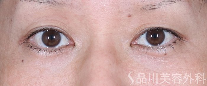 症例NO.72751のBEFORE写真