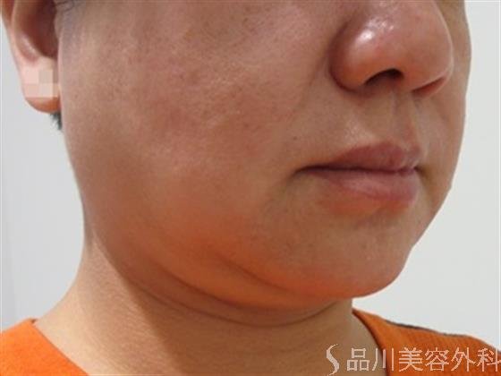 症例NO.33044のBEFORE写真