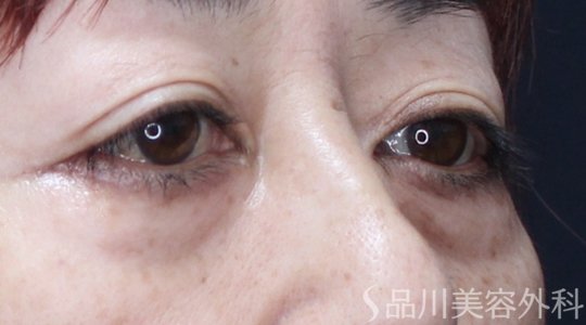 症例NO.71148のBEFORE写真