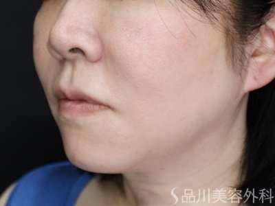 症例NO.72004のAFTER写真