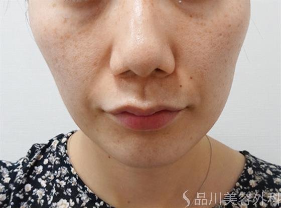 症例NO.51905のBEFORE写真