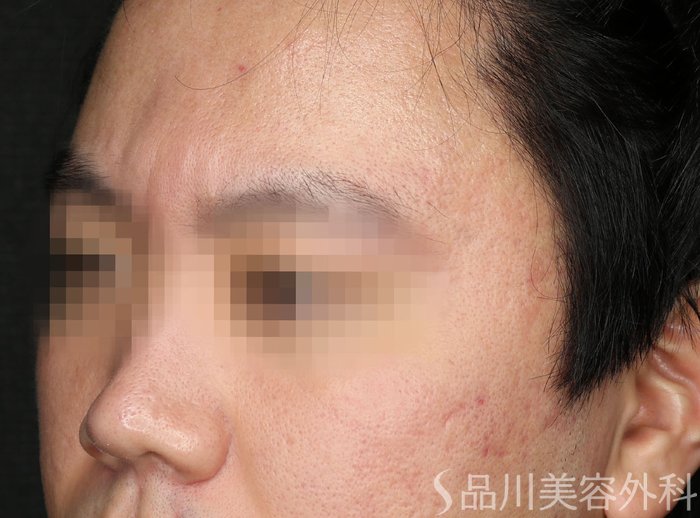症例NO.73950のAFTER写真