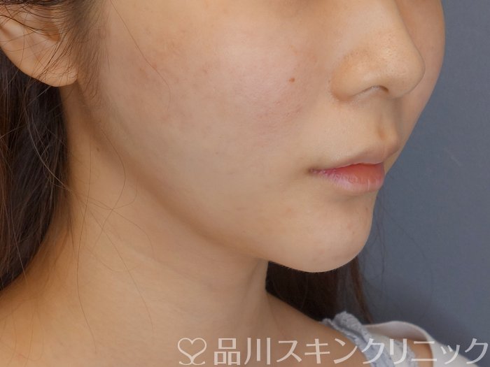 症例NO.71811のAFTER写真