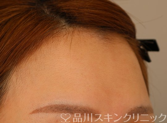症例NO.74268のBEFORE写真