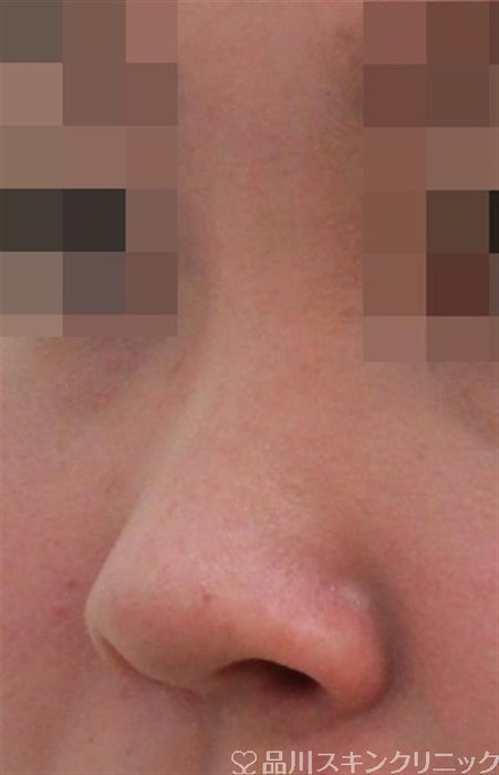 症例NO.32659のBEFORE写真
