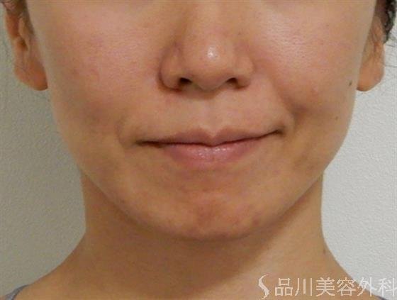 症例NO.39106のBEFORE写真