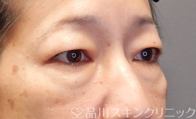 症例NO.68166のBEFORE写真