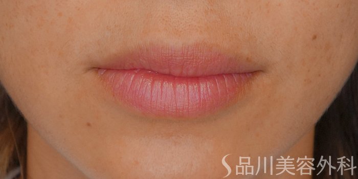 症例NO.70446のBEFORE写真