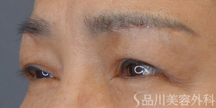 症例NO.72861のAFTER写真