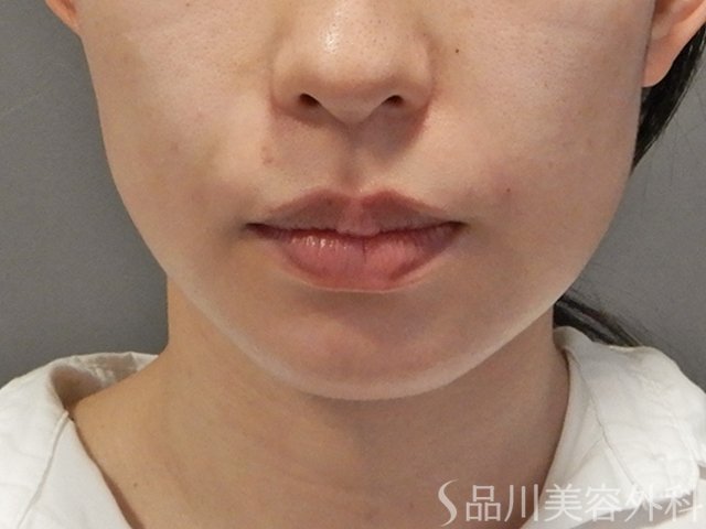 症例NO.74654のAFTER写真