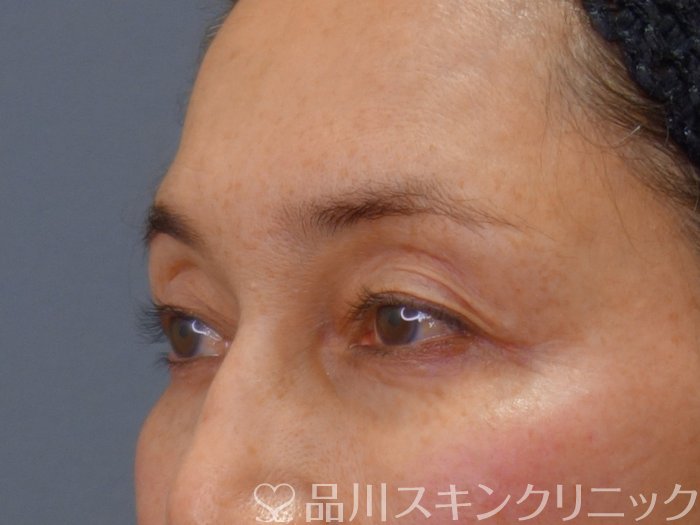 症例NO.73350のBEFORE写真