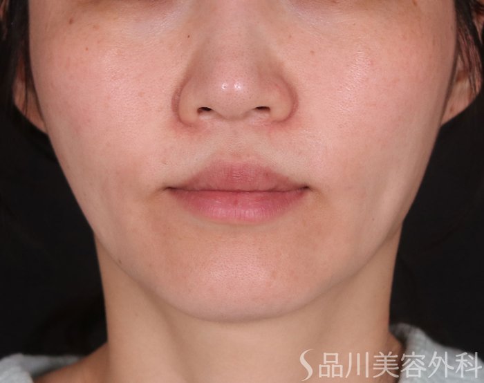 症例NO.73869のBEFORE写真