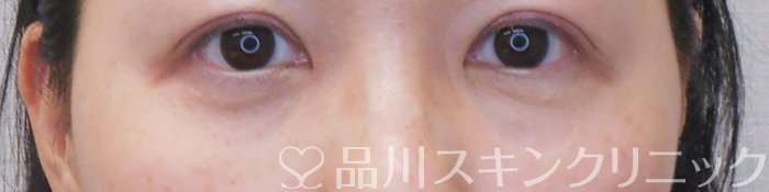 症例NO.71660のAFTER写真
