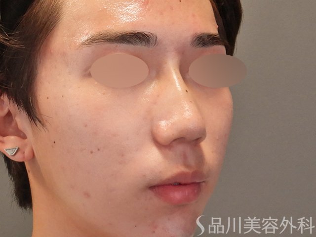 症例NO.74879のAFTER写真