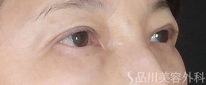 症例NO.73368のAFTER写真