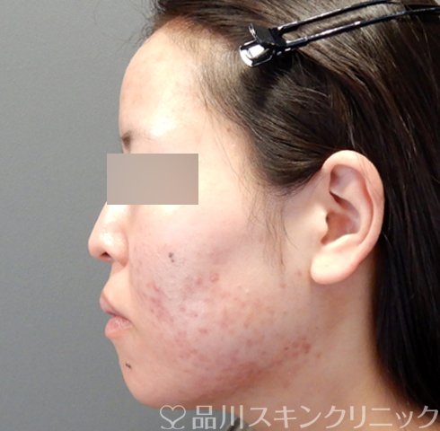 症例NO.70456のAFTER写真