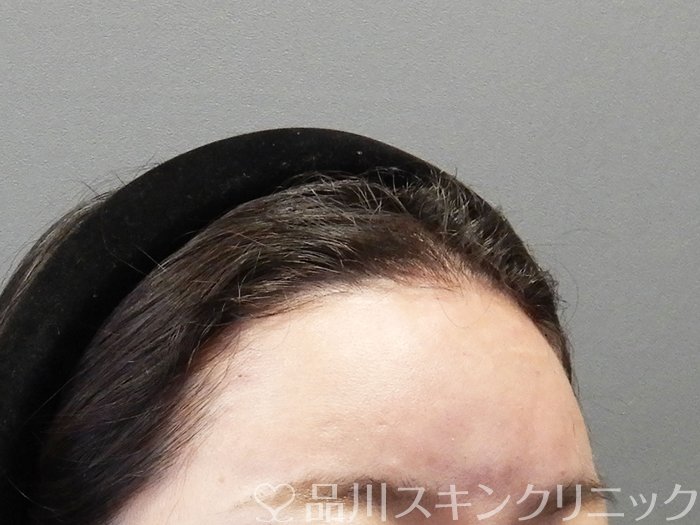 症例NO.75258のAFTER写真