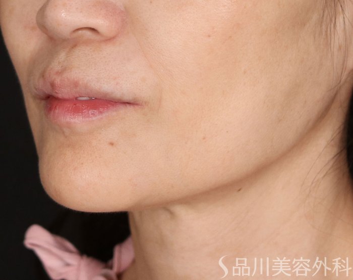 症例NO.71740のBEFORE写真
