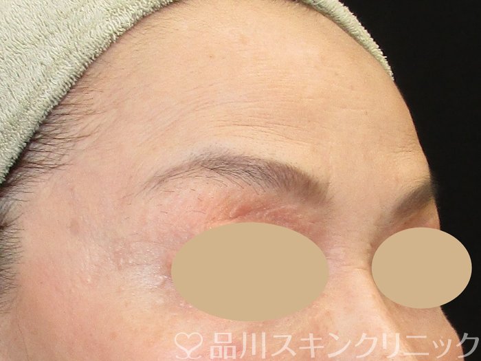 症例NO.74206のBEFORE写真