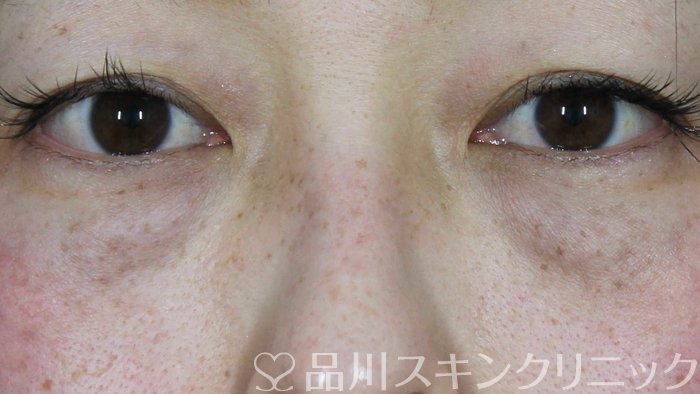 症例NO.71058のBEFORE写真