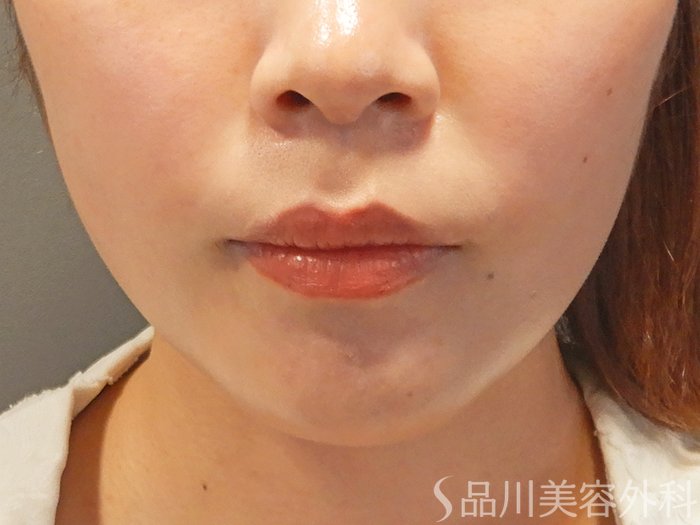 症例NO.70714のAFTER写真