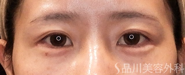 症例NO.70551のAFTER写真