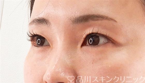 症例NO.58577のBEFORE写真