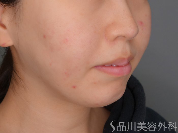 症例NO.73178のBEFORE写真