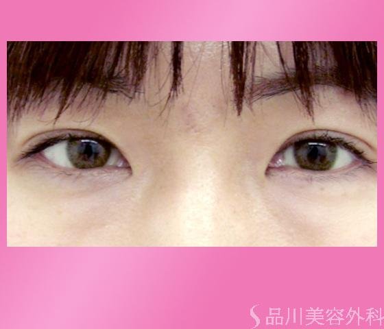 症例NO.1741のAFTER写真