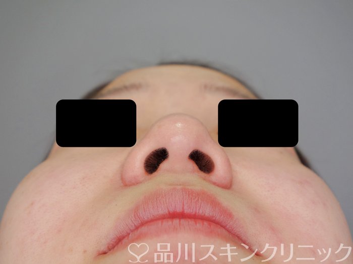 症例NO.73090のBEFORE写真