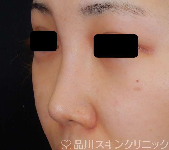 症例NO.64630のBEFORE写真