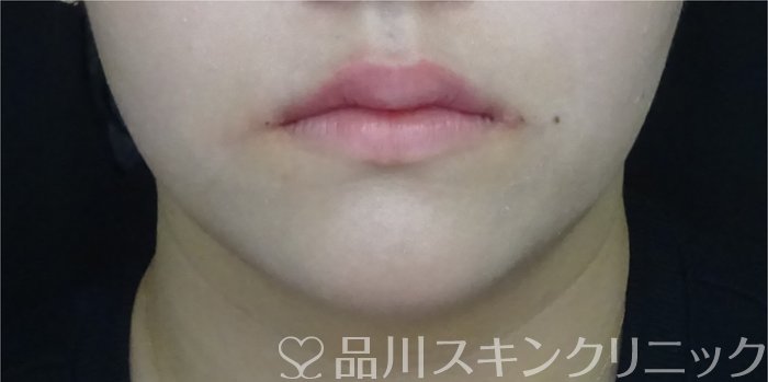 症例NO.71993のAFTER写真