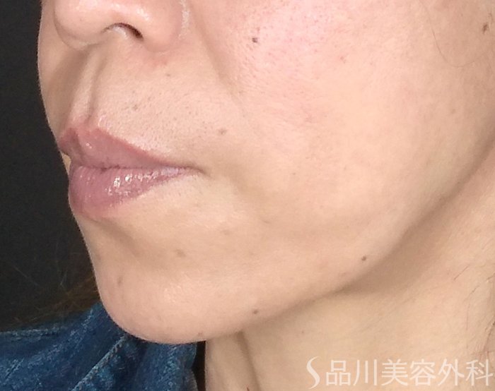 症例NO.65718のAFTER写真