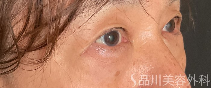 症例NO.75151のAFTER写真