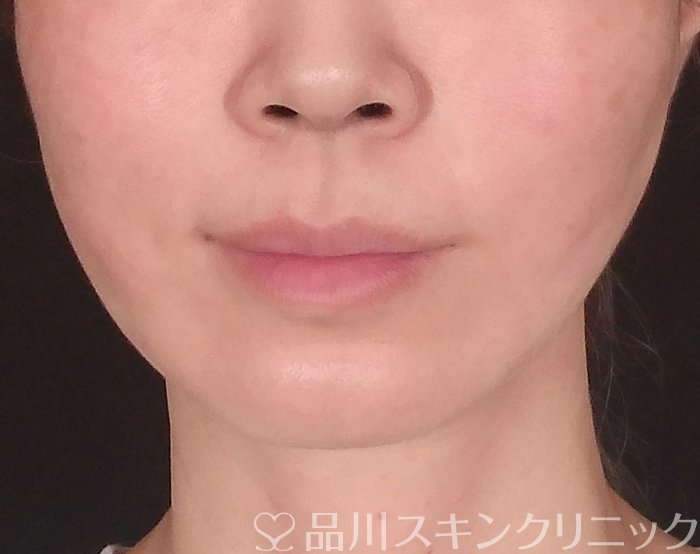 症例NO.69858のAFTER写真