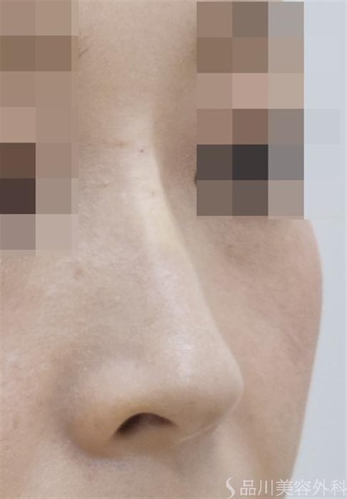 症例NO.47265のAFTER写真