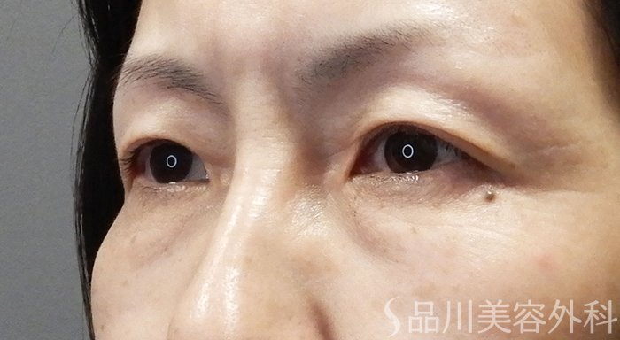 症例NO.70529のBEFORE写真