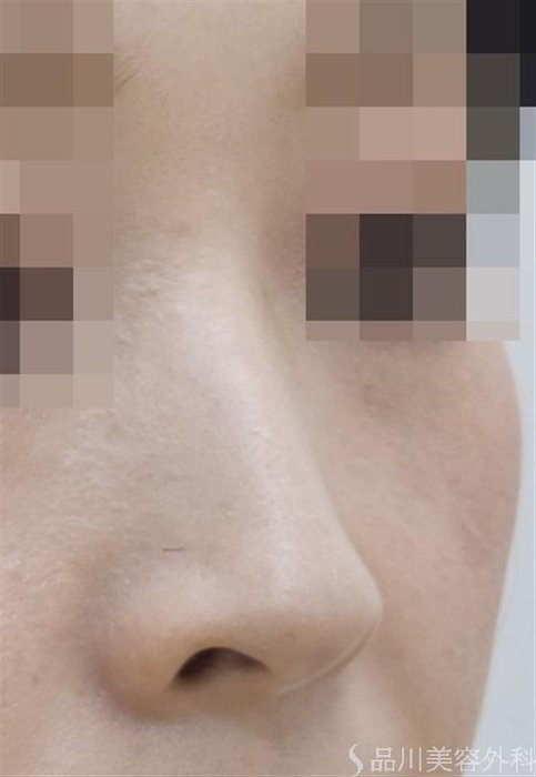 症例NO.47265のBEFORE写真
