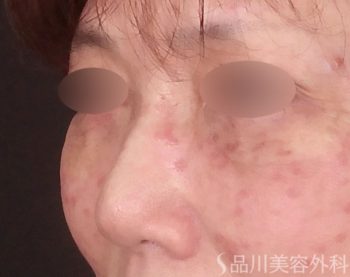 症例NO.71415のAFTER写真