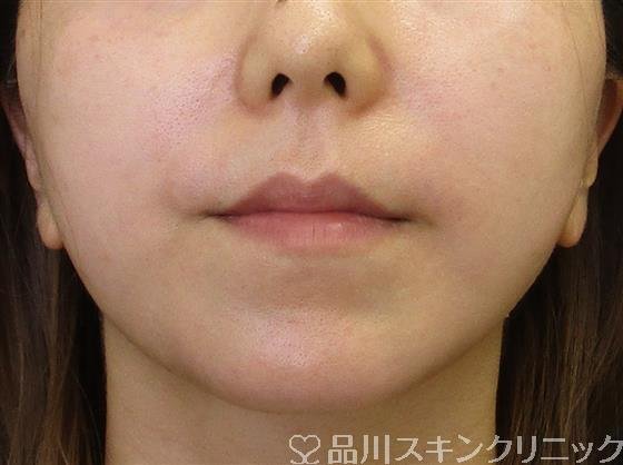 症例NO.59136のAFTER写真