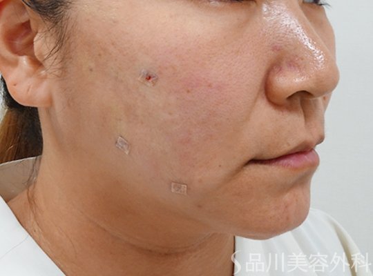 症例NO.72846のAFTER写真