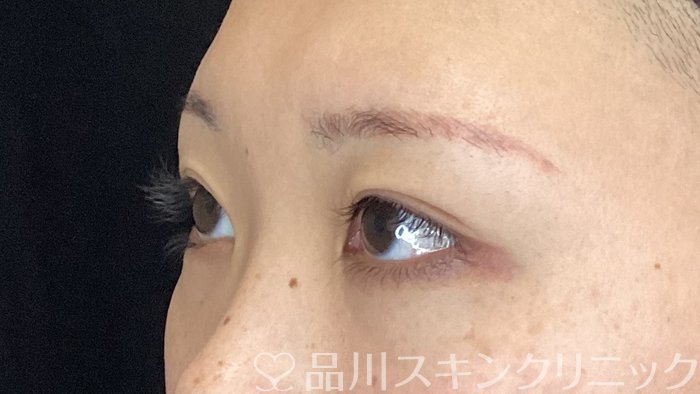 症例NO.75394のBEFORE写真