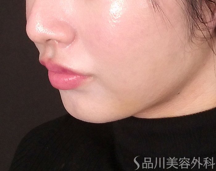 症例NO.69590のBEFORE写真