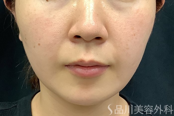 症例NO.63229のBEFORE写真