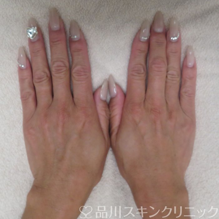 症例NO.71504のBEFORE写真