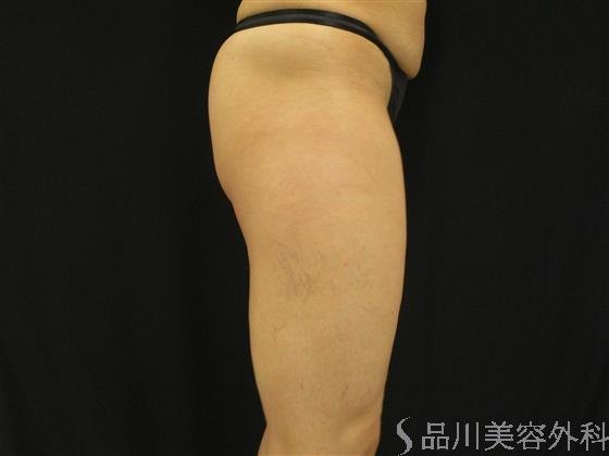 症例NO.52778のBEFORE写真