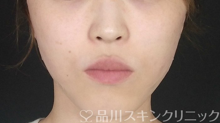 症例NO.71414のAFTER写真