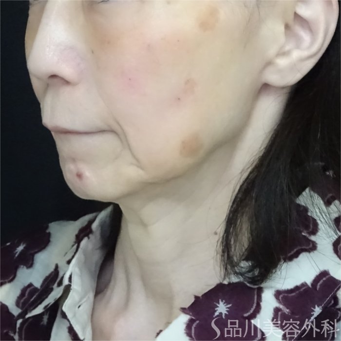 症例NO.70611のAFTER写真